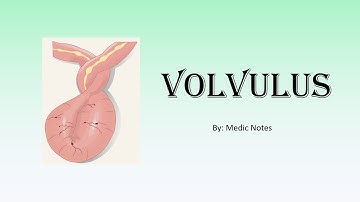 Volvulus - risk factors, clinical features, investigation, treatment, complication