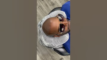 🤩Amazing Transformation Scalp Micropigmentation / On Point SMP Los Angeles #scalpmicropigmentation