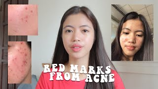 How To Get Rid Of Red Acne Marks (Post-Inflammatory Erythema)