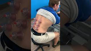 cupping therapy for back pain