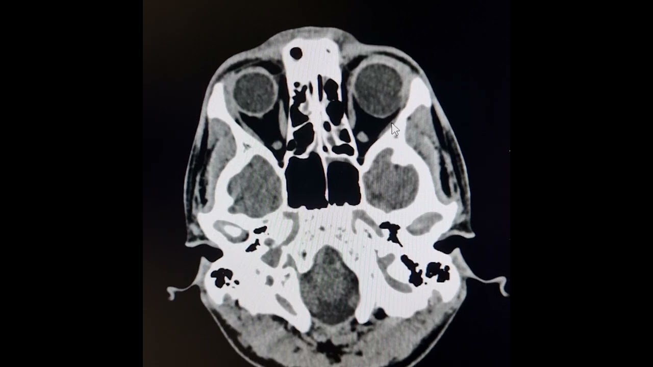 Staphyloma left eye and lateral rectus muscle atrophy.