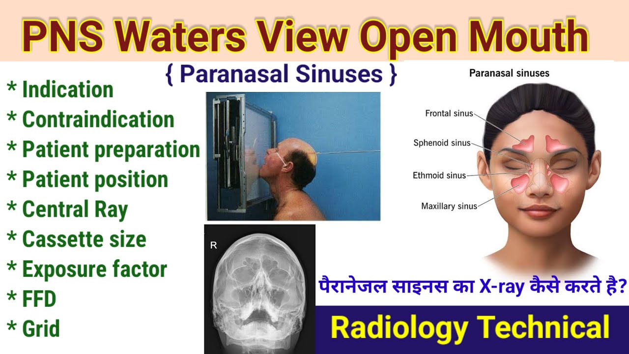 Walters View PNS Waters view # Open mouth X-ray # Parasal sinuses projection ...