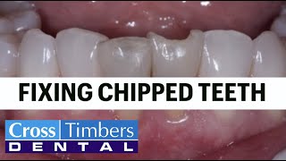 Case of the Week - Fixing chipped teeth