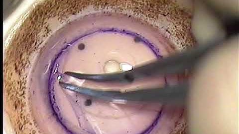 DMEK Graft Preparation