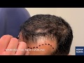 FUE Hair Transplant Procedure & 5 Weeks Post