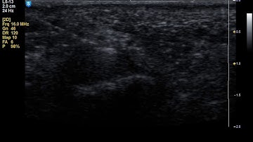 Ultrasound guided in-plane injection of the trigger finger, short axis view of the flexor tendons