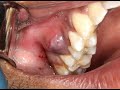 Juicy pus explosion from dental abscess with extraction