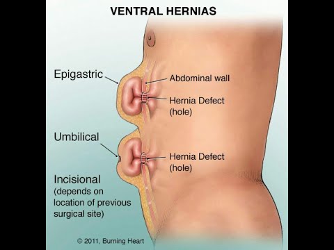 Βίντεο: Τι είναι η κοιλιακή επιγαστρική;
