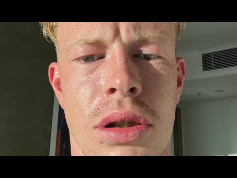 getting veneers in turkey