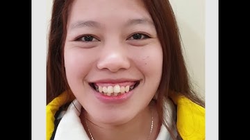 Trước và sau khi gắn mắc cài niềng răng - Niềng sớm, đẹp sớm