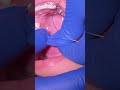 Impacted Canine Braces Treatment - 12 Months of Orthodontic Traction  - Tooth Time Family Dentistry