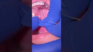 Impacted Canine Braces Treatment - 12 Months of Orthodontic Traction  - Tooth Time Family Dentistry