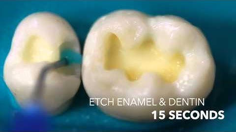 Total Etch and Selective Etch Techniques using Select HV Etch