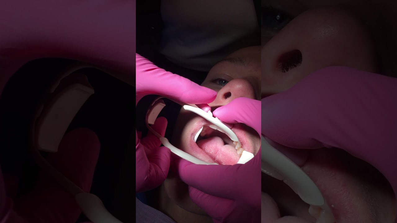 ComfortView Cheek for Indirect Bonding