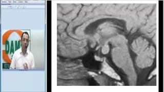 Hypothalamic Hamartoma #Radiology Spotter Series-37 By Dr Sumer Sethi