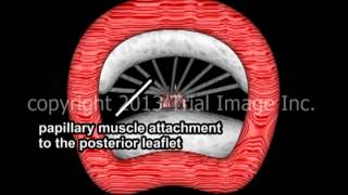 Mitral Valve Prolapse and Mitral Regurgitation by Dr. Cal Shipley, M.D.