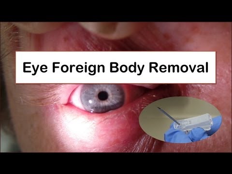 Eye Foreign Body Removal