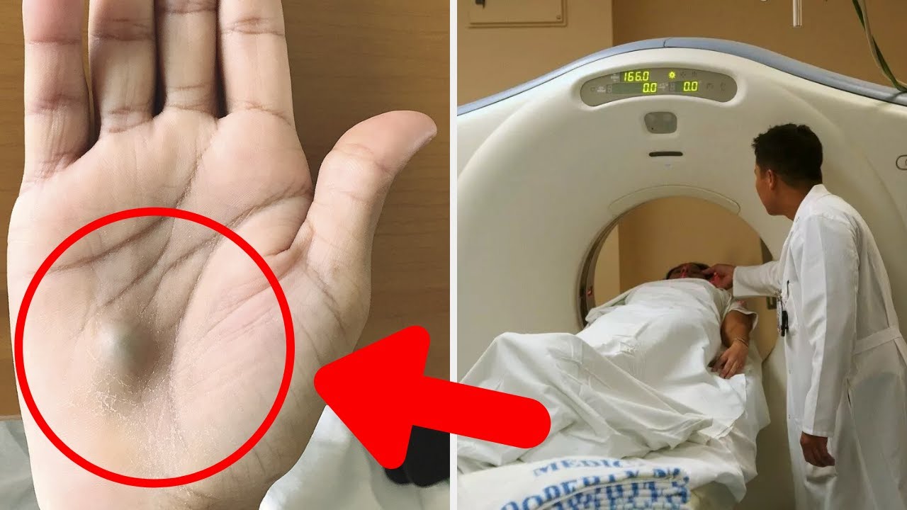 A Man Found This Strange Lump On His Palm Then A Visit To The Doctor