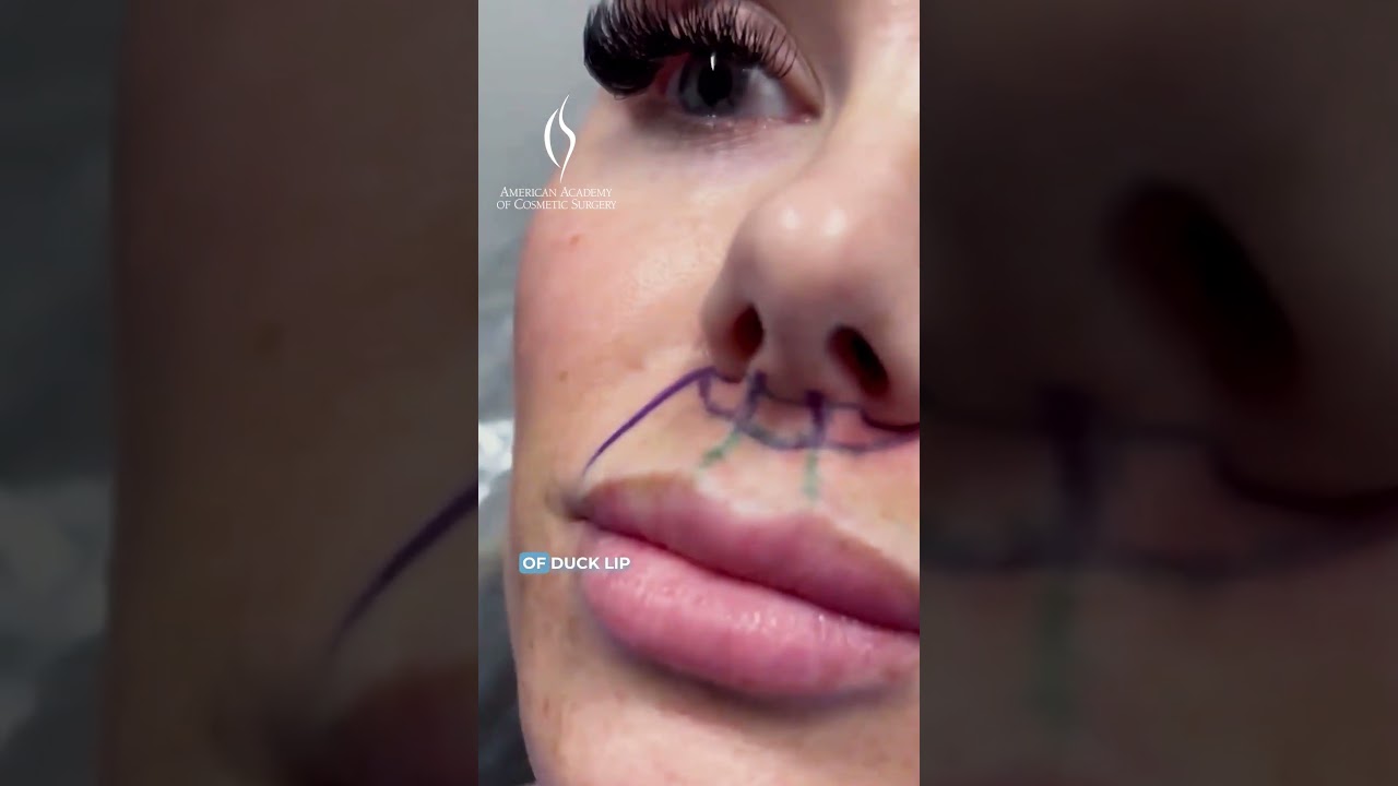 Lip Lifts for Enhanced Smile Aesthetics 