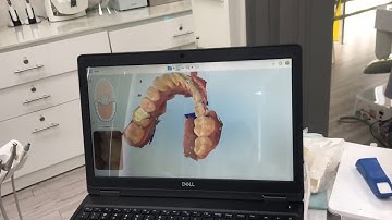 Lấy dấu hàm 3D khi niềng răng Invisalign | White Clinic