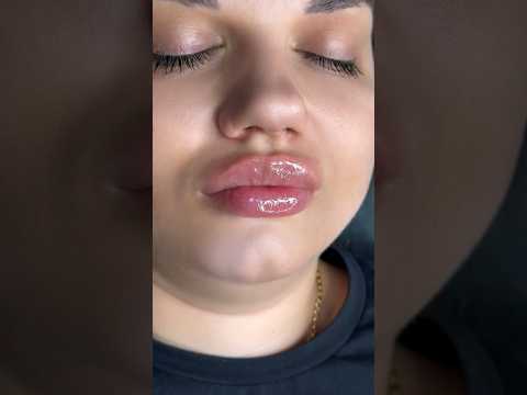 Увеличение губ в самых современных техниках 🔥 #косметологростов