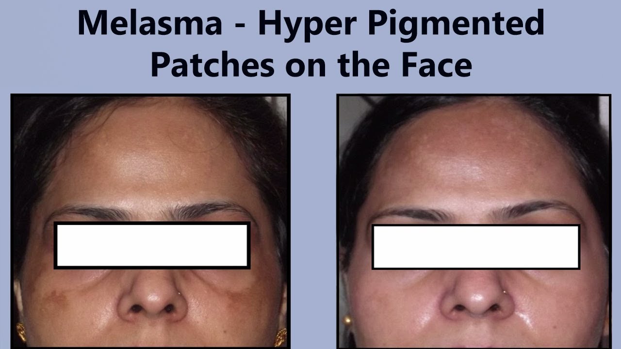 Remove Dark Patches On The Face | Melasma (Hyperpigmentation) Treatment | The Esthetic Clinics