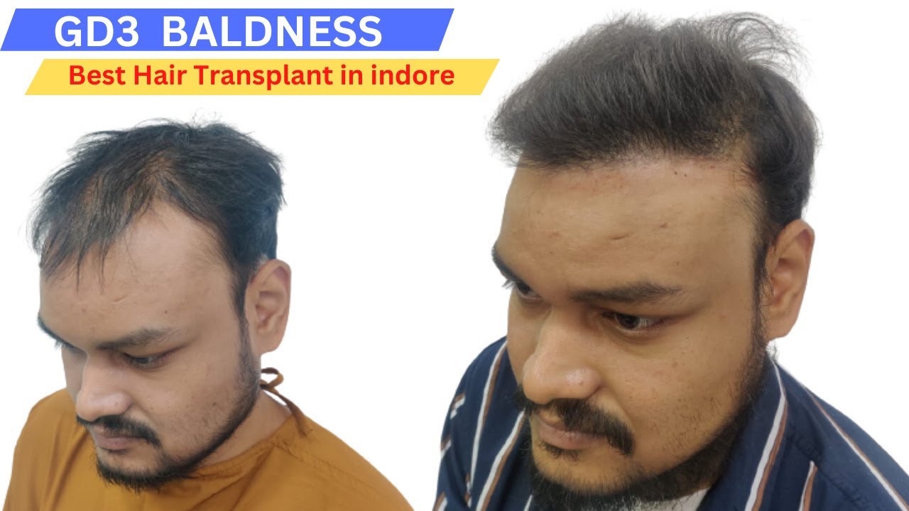 Hair transplant in jabalpur Best hair transplant results jabalpur