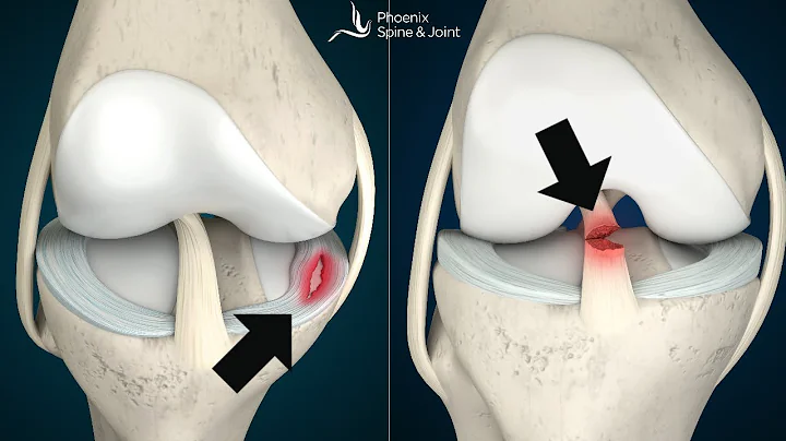 膝の痛みは前十字靭帯損傷かメニスカス損傷か？見分け方とは