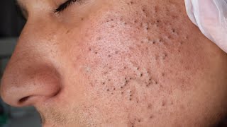 [ASMR] Deep Cleansing Facial Blackhead Extraction & Relaxing Skin Care
