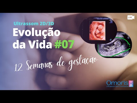 Embarazo 12 semanas. Ultrasonido morfológico (translucencia nucal). Evolución de la Vida #07.