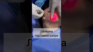 Лазерна ендоскопічна підтяжка обличчя. Ліпосакція другого підборіддя та підтяжка шкіри. #омолодження