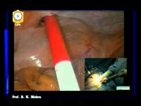 Dr R K Mishra delivering lecture on Laparoscopic Tissue Retrieval Technique Part III