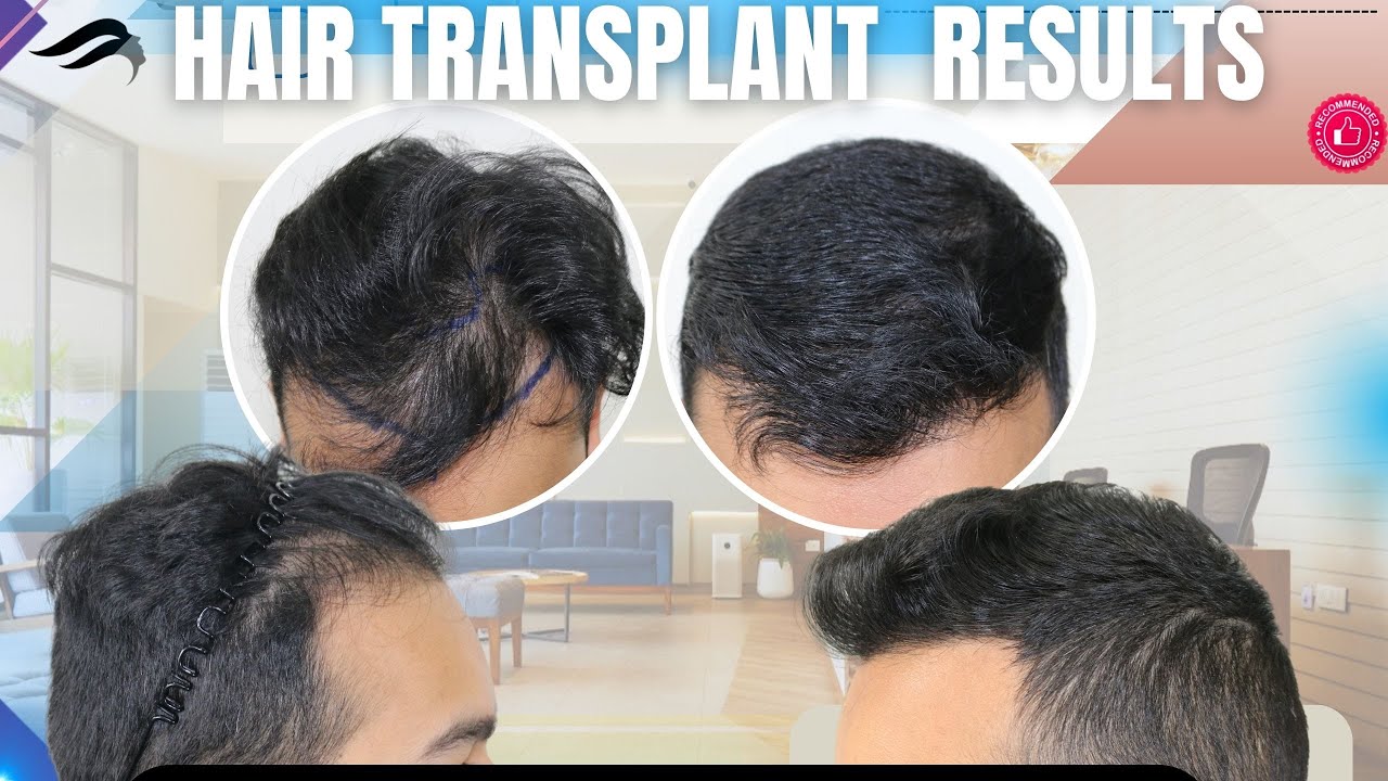 Hair Transplant In Chennai Best Surgeon Cost Clinic & Results Of Hair Transplant Of Chennai