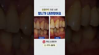 잇몸병 그대로 놔두시면 안 돼요 [명동 시스템치과]