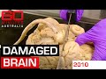 Dissecting an athlete&#39;s brain to determine the real impact of contact sports | 60 Minutes Australia