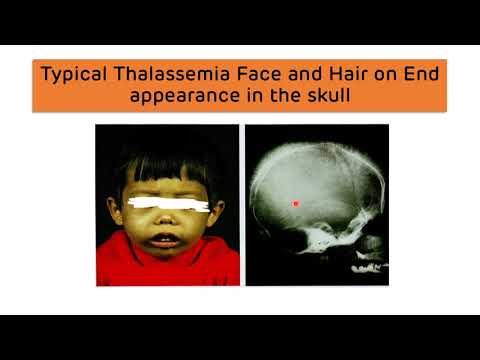 Beta Thalassemia and Alpha Thalassemia - Types, Diagnosis and Treatment || Thalassemia Major & Minor