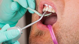 Parodontaltherapie Tiefenreinigungstechniken Für Gesundes Zahnfleisch - Wie Kann Ich Meine Zäh