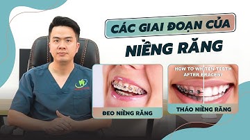 NIỀNG RĂNG SẼ PHẢI TRẢI QUA CÁC GIAI ĐOẠN NÀO?