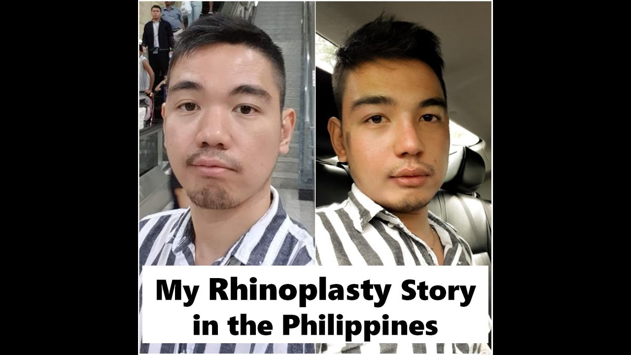 My Rhinoplasty Story in the Philippines YouTube