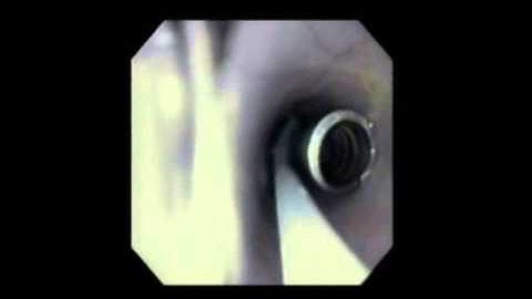 Roth Net  multiple foreign body retrieval