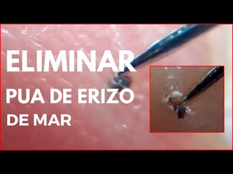 Video: Cómo quitar las espinas de erizo de mar de los pies