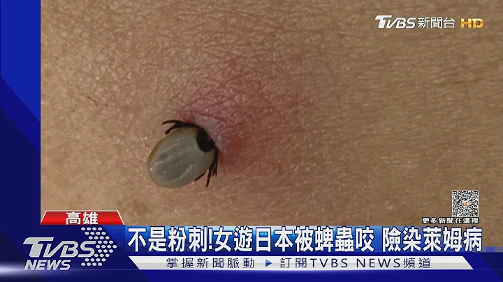 这真的不是粉刺!游日本小心 女被蜱虫咬险染莱姆病｜TVBS新闻 @TVBSNEWS01 - 天天要闻
