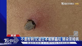 這真的不是粉刺!遊日本小心 女被蜱蟲咬險染萊姆病TVBS新聞 @TVBSNEWS01