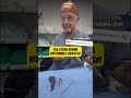 Mais um caso de laser de diodo que falhou: veja a fístula sendo removida por completo #shortsvideo