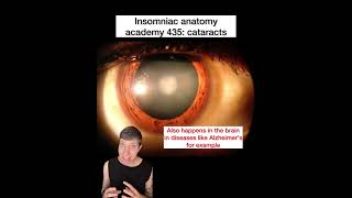 Insomniac anatomy academy 435: cataracts