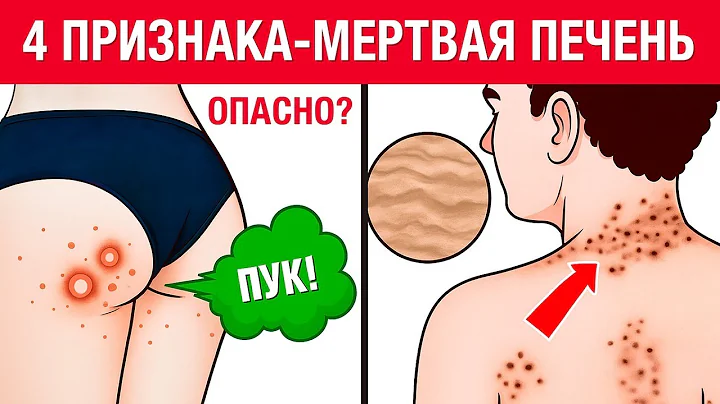 6 главных признаков УМИРАЮЩЕЙ ПЕЧЕНИ! Как быстро проверить здоровье печени?