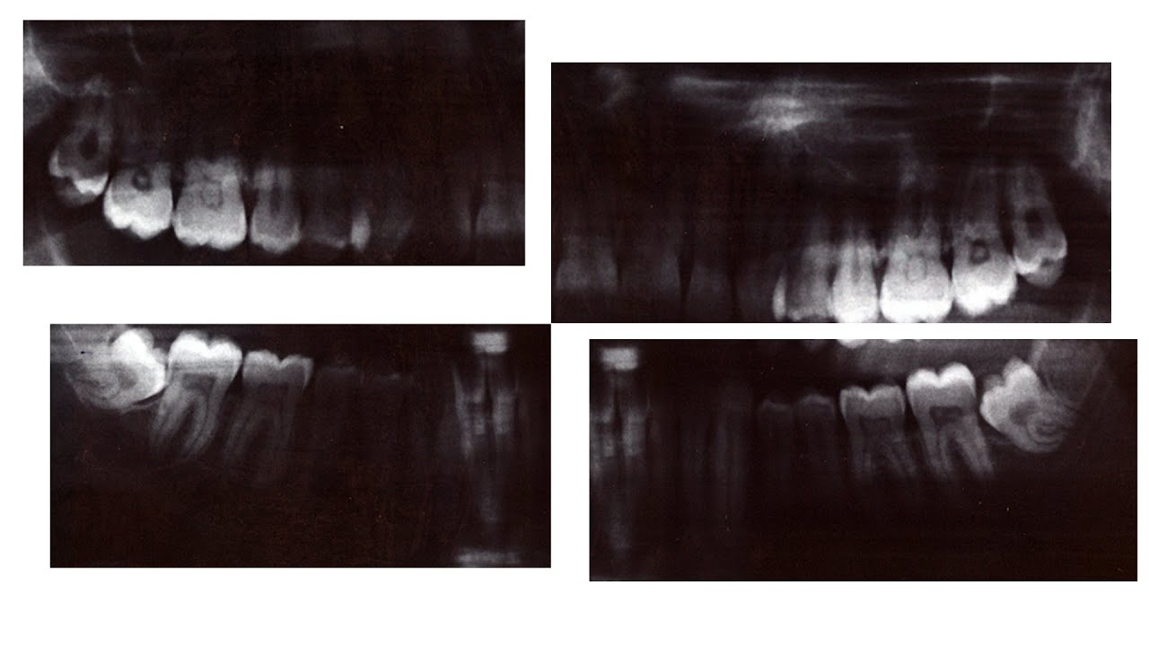 Enveloppes Barrière Pour Plaques Phosphore Radiographie Dentaire - Tailles 0, 1, 2, Neuves
