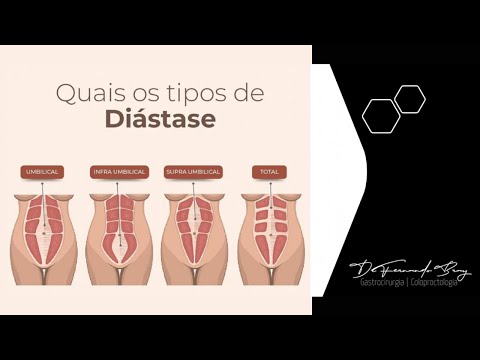Vídeo: Diástase Abdominal Como funciona a Correção de Diástase por Cirurgia Robótica