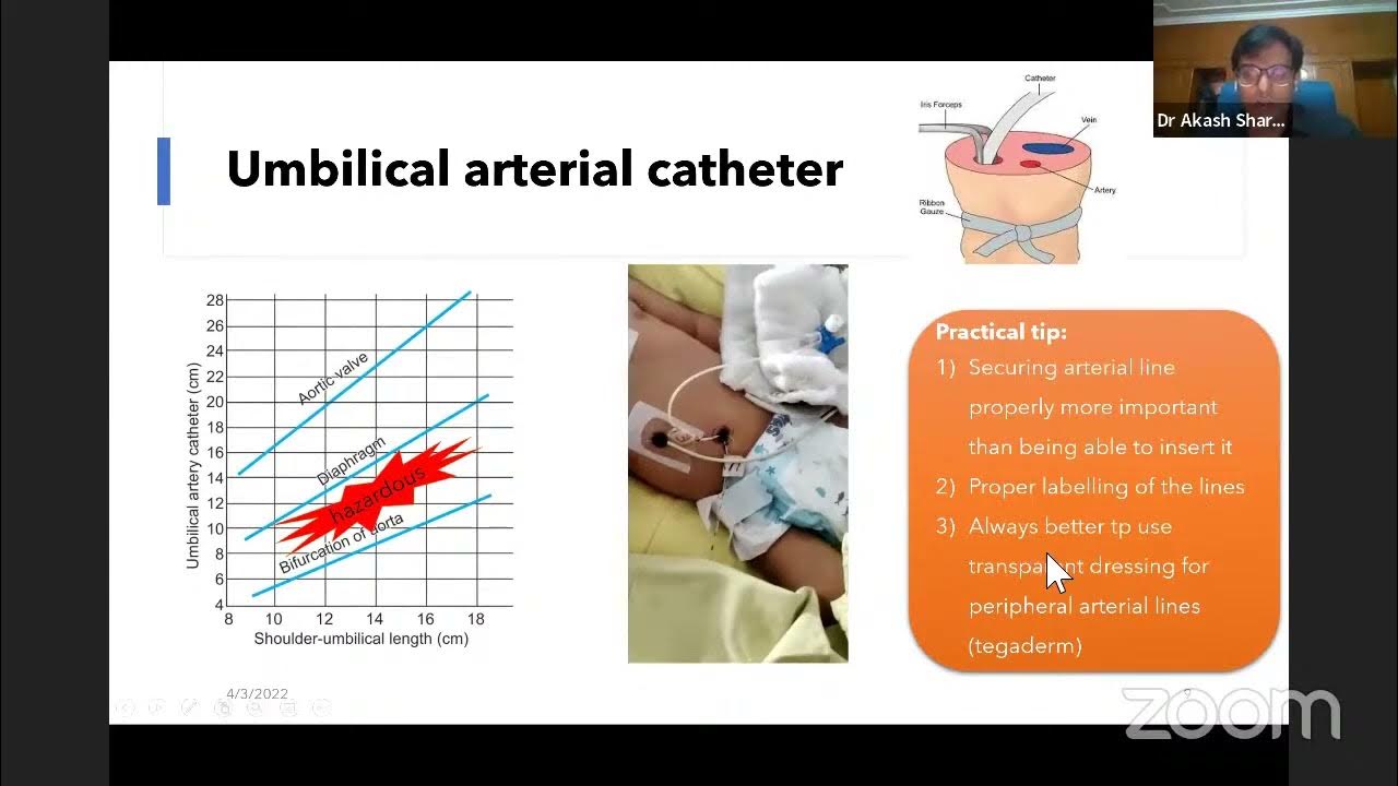 Double volume exchange transfusion and intrarterial bp monitoring in