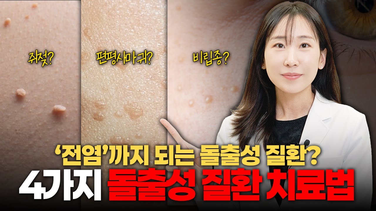 방치하면 큰일나는 4가지 질환? 편평사마귀, 비립종, 쥐젖, 요철 저도 이렇게 없앴습니다 - YouTube